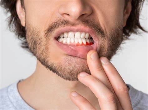 Gingivitis and Aphthous Stomatitis: How to Stop Gum Bleeding Immediately 2 Gingivitis and Aphthous Stomatitis: How to Stop Gum Bleeding Immediately