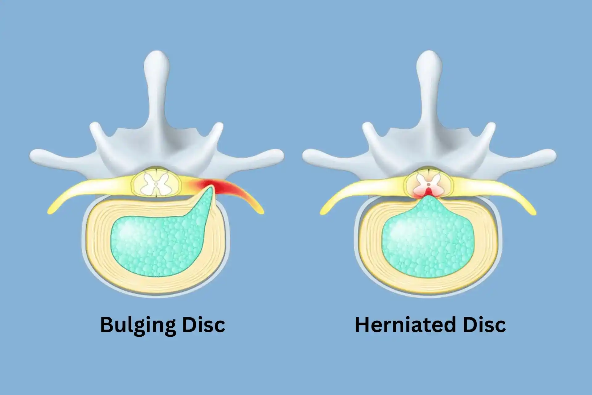 Herniated or Bulging Disc