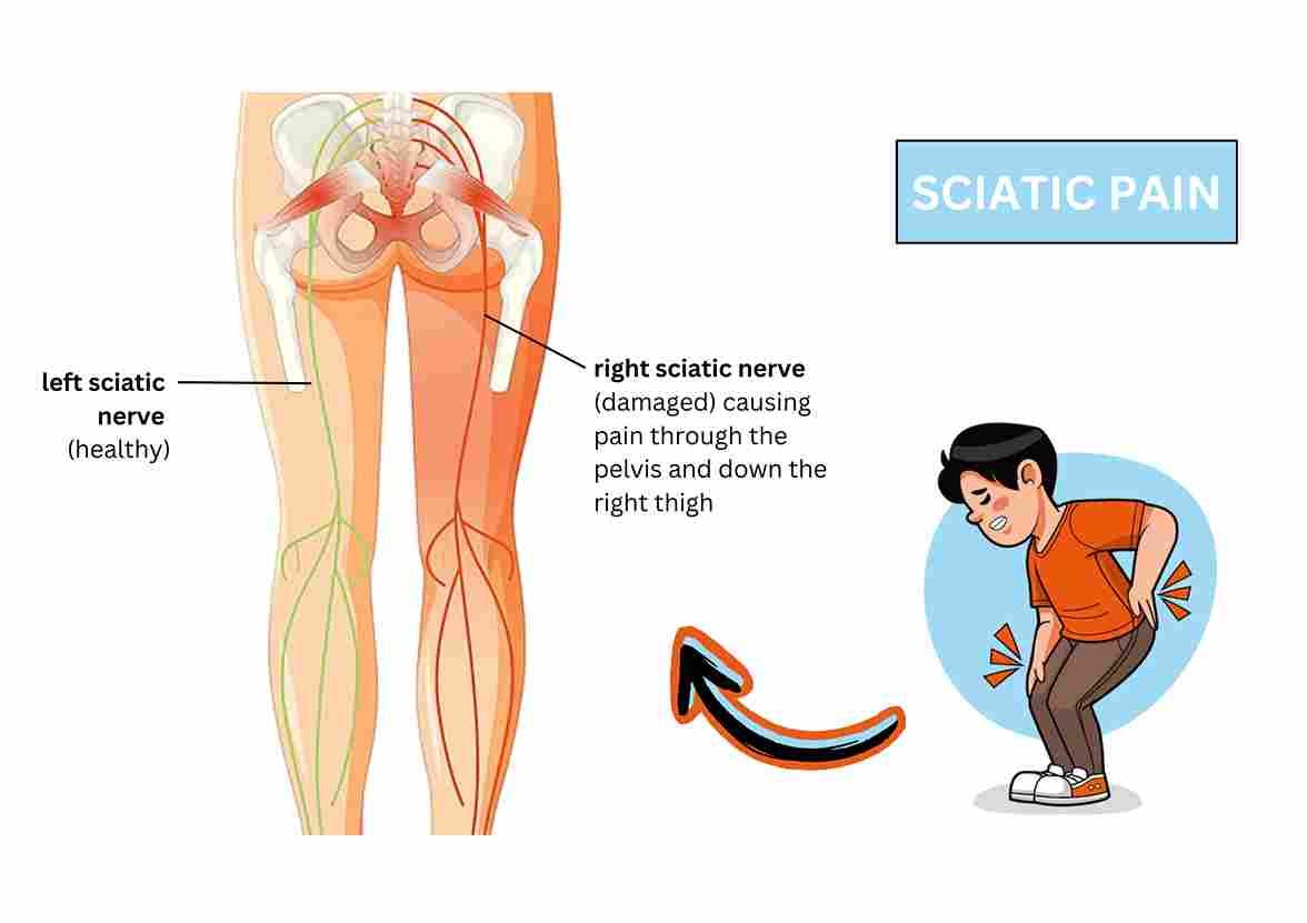 Sciatica Pain Triggered by Nerve Compression